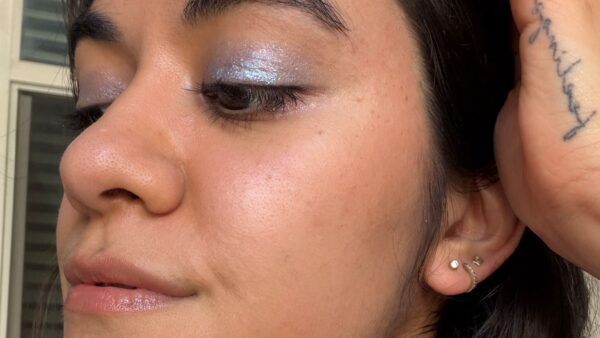 I Thought My Hyperpigmentation Was Acne Scarring — Until A Dermatologist Told Me Otherwise